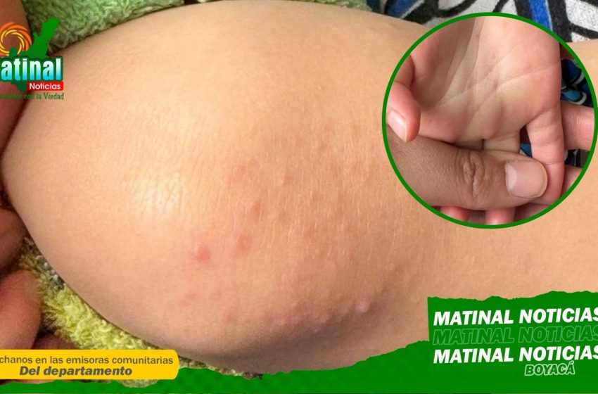  Secretaría de Salud de Boyacá emite recomendaciones por casos de enfermedad de mano, pie y boca en población infantil